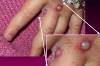 12 Negara Laporkan Monkeypox, Pria Penyuka Sesama Jenis Paling Rentan