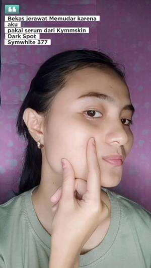 Punya bekas jerawat yang susah hilang??? cobain pakai serum ini deh🤏  #skincare  #trending  #fyp  #LaguViral 