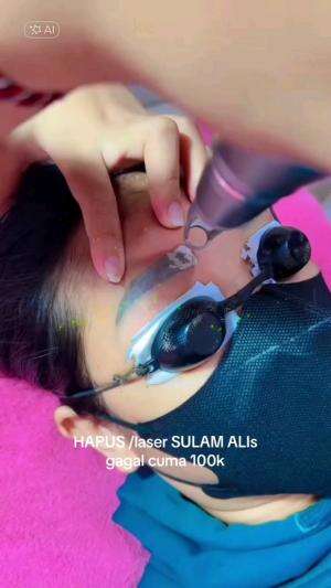 HAPUS / LASER SULAM ALIS😍🥰#RCTIPlus #shortplus #sulamalis #treatment #beauty #kecantikan 