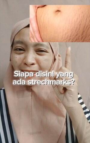 siapa nih yang ada Strechmarks