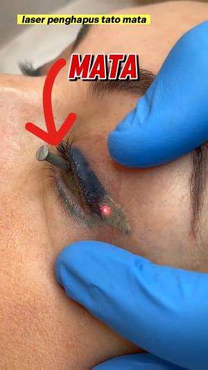 laser penghapus tato mata #laser #penghapus #tato #mata