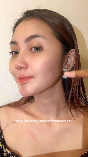 Semoga membantu yaa #breakout #solusibeauty #chikaaprlaa #27122025