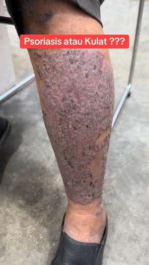 jangan pelihara eksim sebelum jadi parah kayak gini