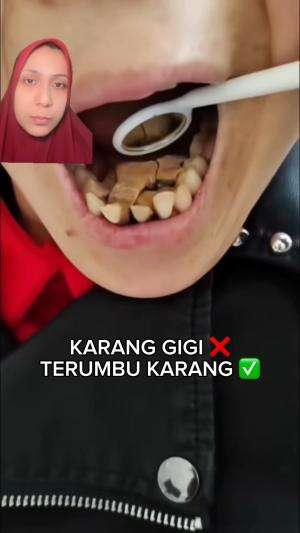 JANGAN PELIHARA KARANG GIGI SAMPE JADI TERUMBU KARANG‼️ 