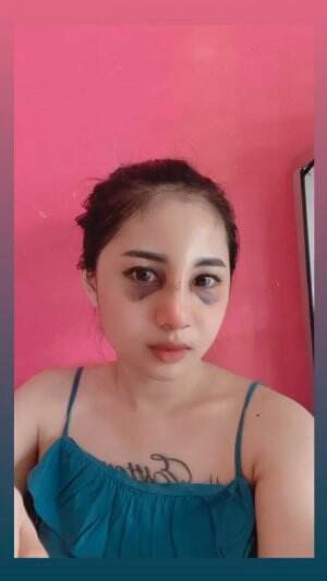 Muka habis oprasi hidung🤗🤗