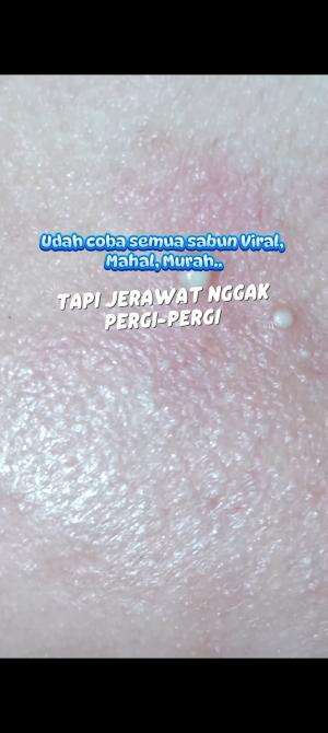 Bag. II
Hempaskan jerawat ☺️

#glowsoap #sabuncucimuka #SabunViral #RCTIPlus #HOTrctiplus #fyp 