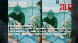 Polisi Beberkan Hasil Visum Lesti Kejora