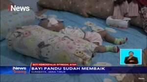 Bayi Hidrosefalus Ditinggal Ayah, Menunggu Pemeriksaan Rekonstruksi Wajah