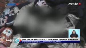Penyakit Aneh Menimpa Kakak Beradik Ini