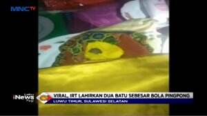Viral! Diluar Kewajaran Ibu Lahirkan Dua Batu Sebesar Bola Pingpong