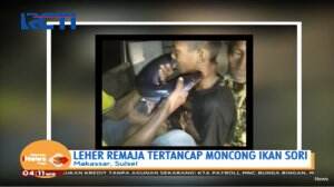 Leher Seorang Remaja di Makassar di Operasi Selama 1 Jam Akibat Tertancap Ikan Marlin