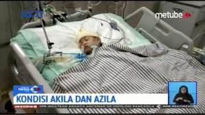 Kondisi Terkini Bayi Kembar Siam