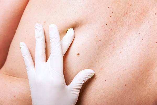 Cegah Kanker Kulit Pakai Sunscreen