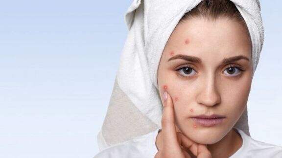 Waspada Beauty! Bukan Jerawat, Bisa Jadi Itu Bisul! Kenali 3 Perbedaannya