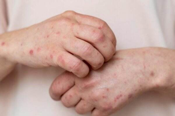 Cacar Monyet Berpotensi Menyebar di Indonesia, Ini Penjelasan Ahli Epidemiologi
