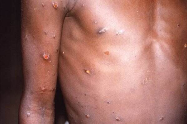 Dokter Pastikan Cacar Monyet Tidak Menular Lewat Udara