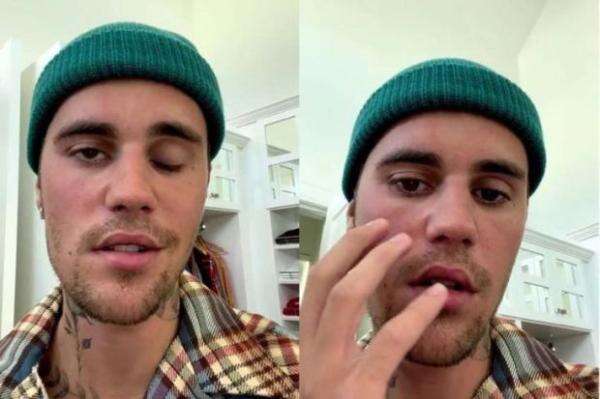 Beda Ramsay Hunt Syndrome yang Diidap Justin Bieber dengan Bells Palsy ...