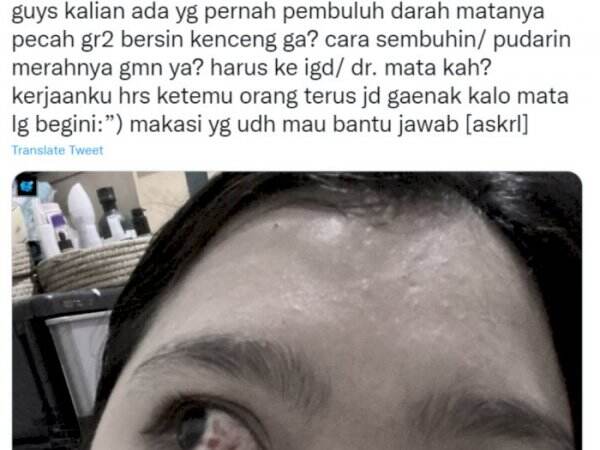 Heboh Pembuluh Darah Mata Pecah Akibat Bersin Terlalu Kencang Ini