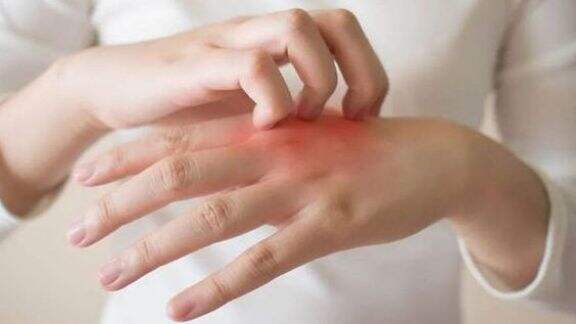 4 Obat Alami Ini Ampuh Sembuhkan Eksim, Apa Saja?