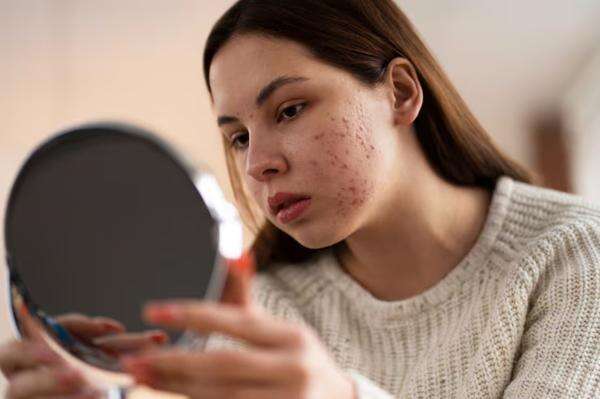 Jerawatan Setelah Ganti Skincare Tak Selalu Purging, Ini Cara Membedakannya Jerawatan Setelah Ganti Skincare Tak Selalu Purging, Ini Cara Membedakannya