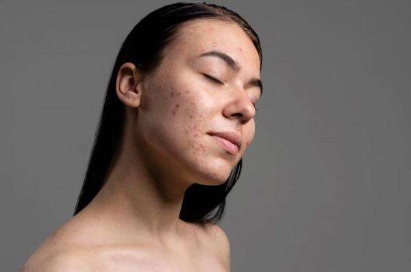 Penyebab Dark Spot di Wajah Susah Hilang Penyebab Dark Spot di Wajah Susah Hilang