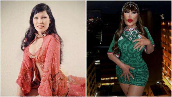 Mengerikan! Ini Efek Samping Suntik Minyak Goreng ke Wajah seperti Dialami Lyn May Mengerikan! Ini Efek Samping Suntik Minyak Goreng ke Wajah seperti Dialami Lyn May