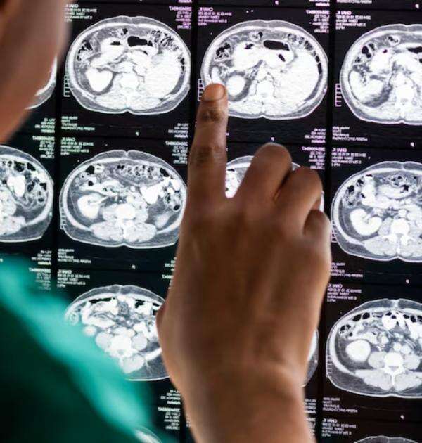 Mengenal Penyakit Stroke yang Diidap Ibunda Zaskia Adya Mecca Mengenal Penyakit Stroke yang Diidap Ibunda Zaskia Adya Mecca