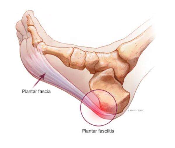 Mengenal Plantar Fasciitis, Peradangan Jaringan yang Sebabkan Nyeri Hebat di Tumit Mengenal Plantar Fasciitis, Peradangan Jaringan yang Sebabkan Nyeri Hebat di Tumit