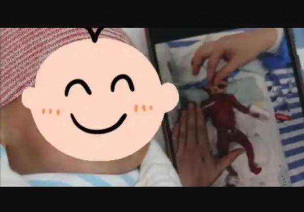 Kisah Bayi Lahir Prematur Beratnya Cuma 330 Gram Seukuran Telapak Tangan hingga Bisa Hidup Sehat Kisah Bayi Lahir Prematur Beratnya Cuma 330 Gram Seukuran Telapak Tangan hingga Bisa Hidup Sehat
