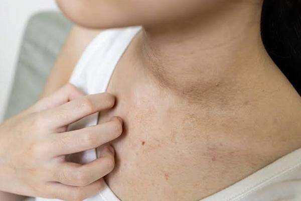 Sering Dikira Daki, Bercak Hitam di Leher Bisa Jadi Tanda Resistensi Insulin Sering Dikira Daki, Bercak Hitam di Leher Bisa Jadi Tanda Resistensi Insulin