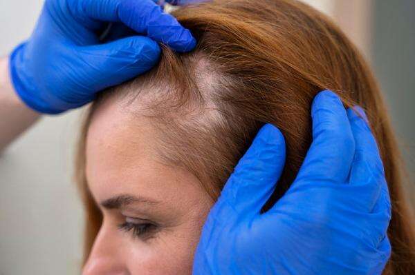 Apa Itu Alopecia Areata? Kondisi Rambut Rontok dengan Bercak Parah Apa Itu Alopecia Areata? Kondisi Rambut Rontok dengan Bercak Parah