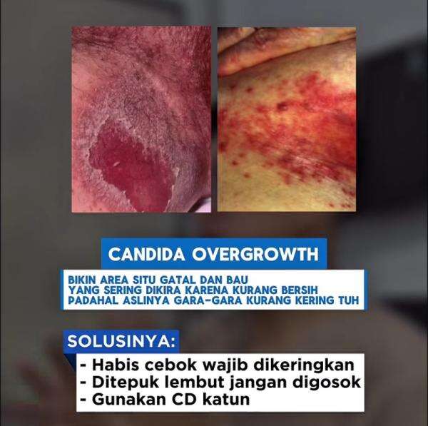 Ngeri! Cebok Enggak Bersih Picu Jamur di Area Selangkangan Ngeri! Cebok Enggak Bersih Picu Jamur di Area Selangkangan