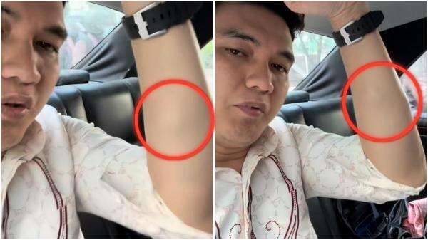 Aldi Taher Operasi Benjolan di Tangan, Ada Kaitannya dengan Riwayat Kanker Limfoma? Aldi Taher Operasi Benjolan di Tangan, Ada Kaitannya dengan Riwayat Kanker Limfoma?