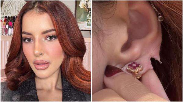 Ngeri Banget! Kuping Tasya Farasya Sobek Terbelah Dua Ngeri Banget! Kuping Tasya Farasya Sobek Terbelah Dua