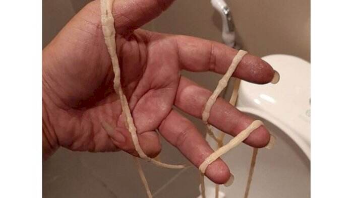 Mengeluh Susah BAB, Ternyata Ada Cacing Pita 9 Meter Sumbat Anus Pria Ini
