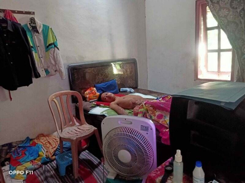 Sempat Viral, Kemudian Hutang Keluarga Luka Bakar di Atas Daun Pisang Dibebaskan