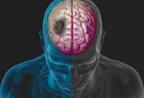 Tips Sederhana Turunkan Risiko Stroke, Lakukan Ini di Pagi Hari