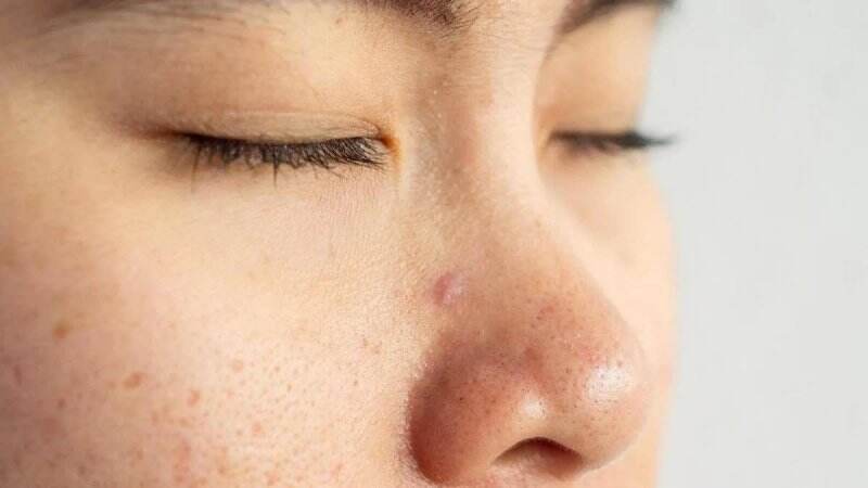 Rahasia dan Cara Mengecilkan Pori-Pori Wajah dari Dermatolog