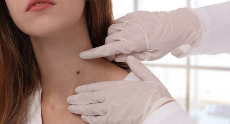 Menurunkan Rasa Percaya Diri, Ini 5 Cara Alami Menghilangkan Skin Tag