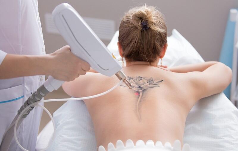 Amankah Menghapus Tato Pakai Laser? Ini Kata Dokter
