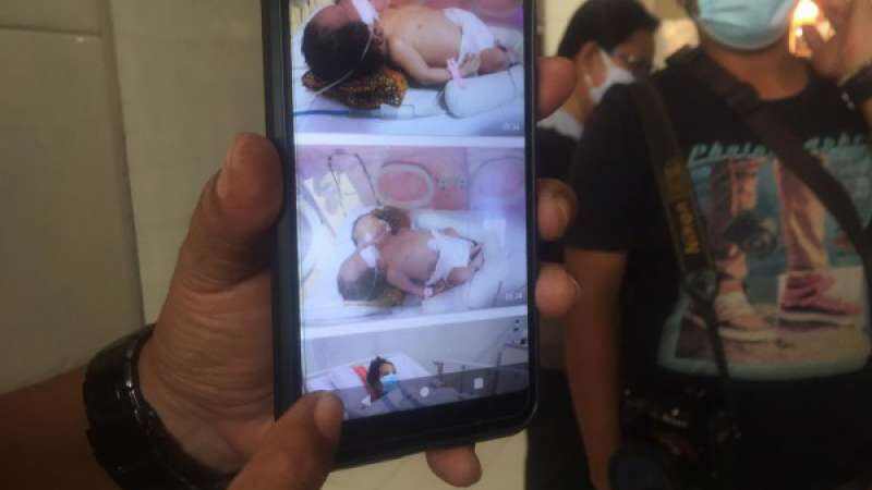 Bayi Kembar Siam Dua Kepala dengan Satu Tubuh Belum Stabil, Ibu Bayi: Selama Hamil Tak Terasa Aneh-aneh