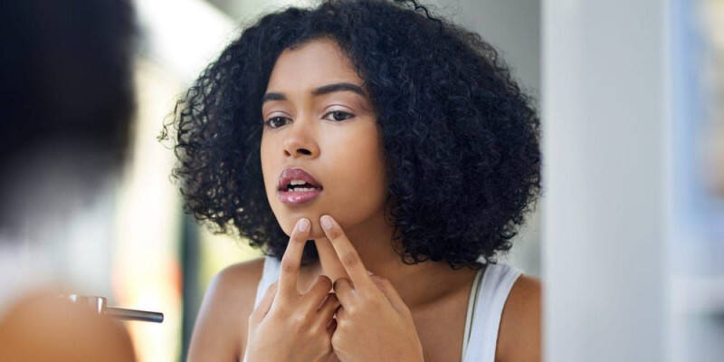 Pentingnya Kandungan Vitamin A di Skincare untuk Melawan Jerawat