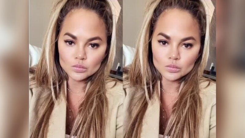 Chrissy Teigen Operasi Lemak Pipi, Kini Lebih Tirus!