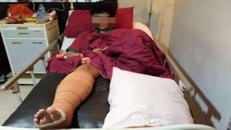 Diduga Disetrum dan Diinjak Oknum Polisi, Kaki Siswa SMP Patah dan Harus Dioperasi Rp100 Juta