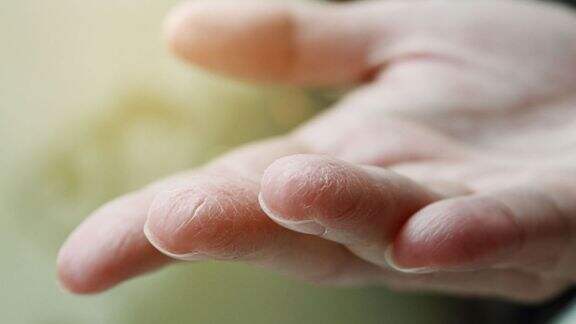 Serem Banget! Diabetes Bisa Sebabkan Kulit Melepuh, Ini Tanda-tandanya Moms