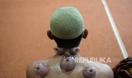 Bekam Bantu Tingkat Respons Imun Vaksin Covid-19?