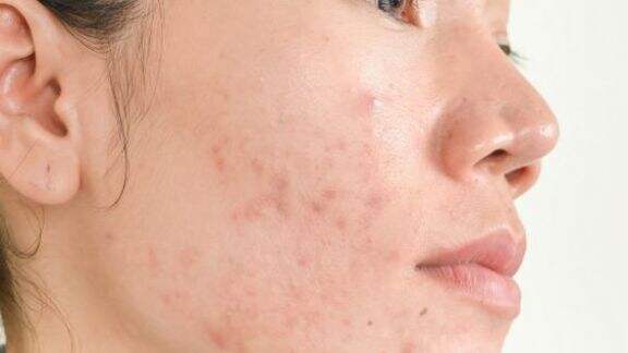 Cuss Dicoba Nih, Beauty! 8 Cara Hilangkan Bekas Jerawat