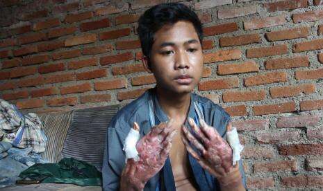 Alami Luka Bakar, Tangan Warga Miskin Terancam Diamputasi