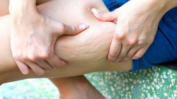 Nahas, Perawatan Stretch Mark Bikin Jantung Wanita Ini Meledak