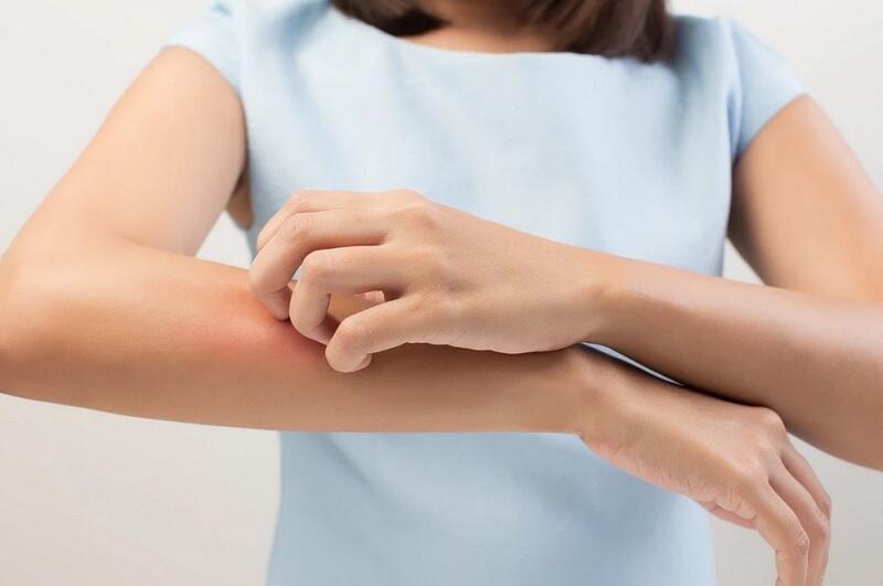 Bisakah Pakai Natural Oil untuk Hilangkan Bekas Dermatitis Atopik?
